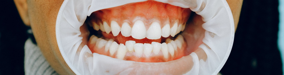Boca de uma pessoa em zoom, com os dentes à mostra durante uma consulta odontológica
